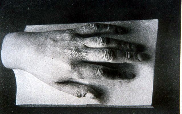 1932-05-03, 72,  Anton Wildgans, Gipsabdruck der linken Hand